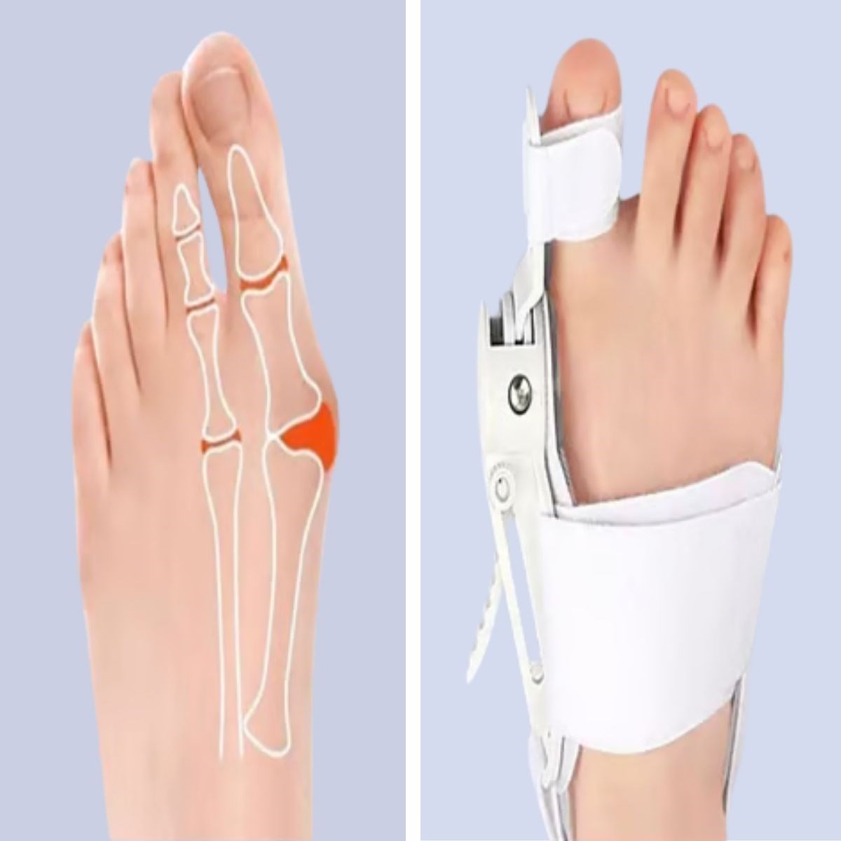 BUFFER® Ayarlanabilir Ayak Baş Parmak Kemik Düzeltici – Halluks Valgus (Bunyon) Aparatı, Gece Gündüz Kullanıma Uygun Ayak Düzeltme Ateli