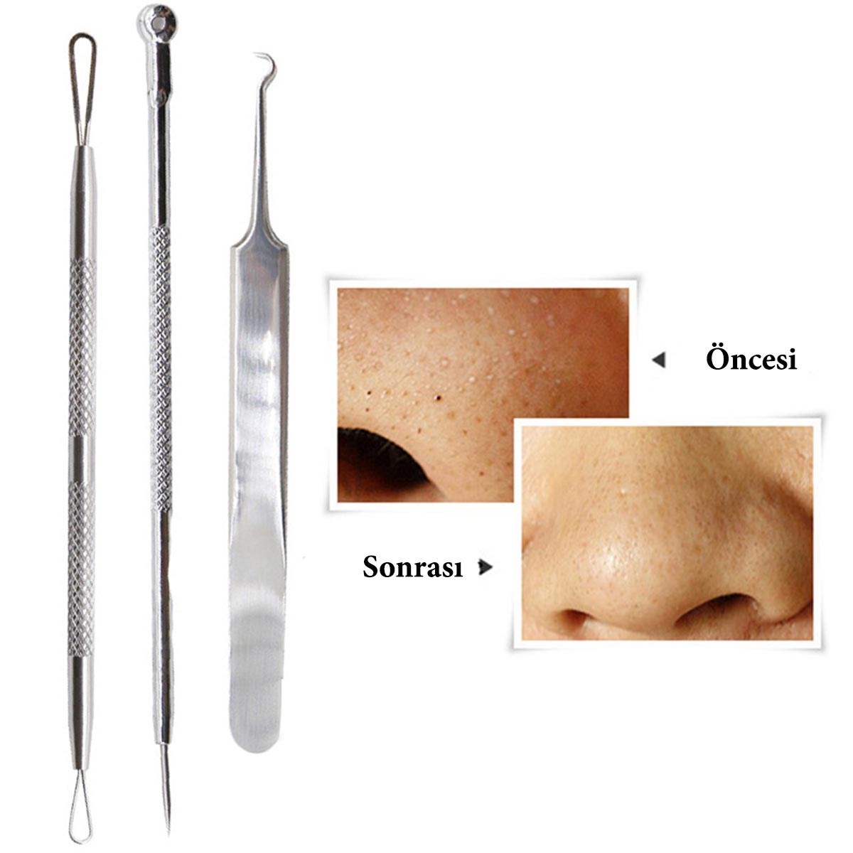 BUFFER® Paslanmaz Çelik Siyah Nokta Sivilce ve Akne Temizleyici Set 3lü Kit